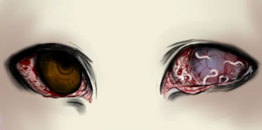 Eye Trauma….